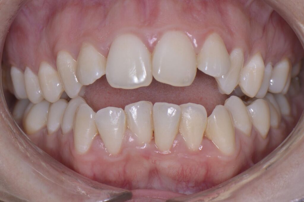Antes