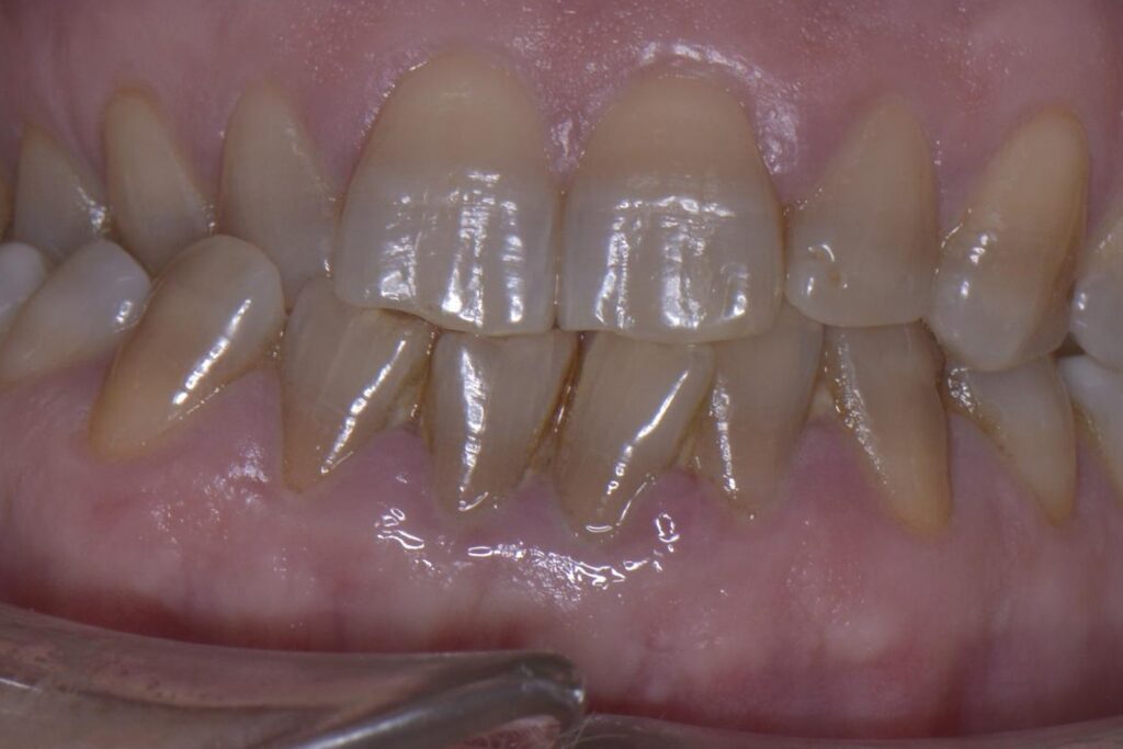 Antes