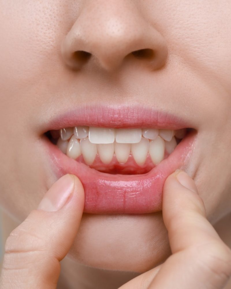Encías sanas tras el tratamiento de periodoncia en Logroño