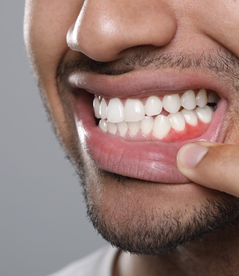 Encías sanas después del tratamiento periodontal en Logroño