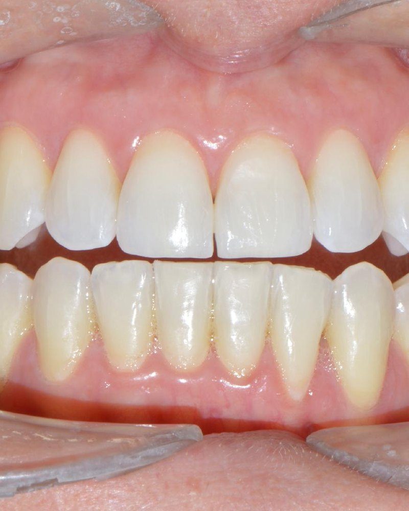 Sonrisa después de un blanqueamiento dental