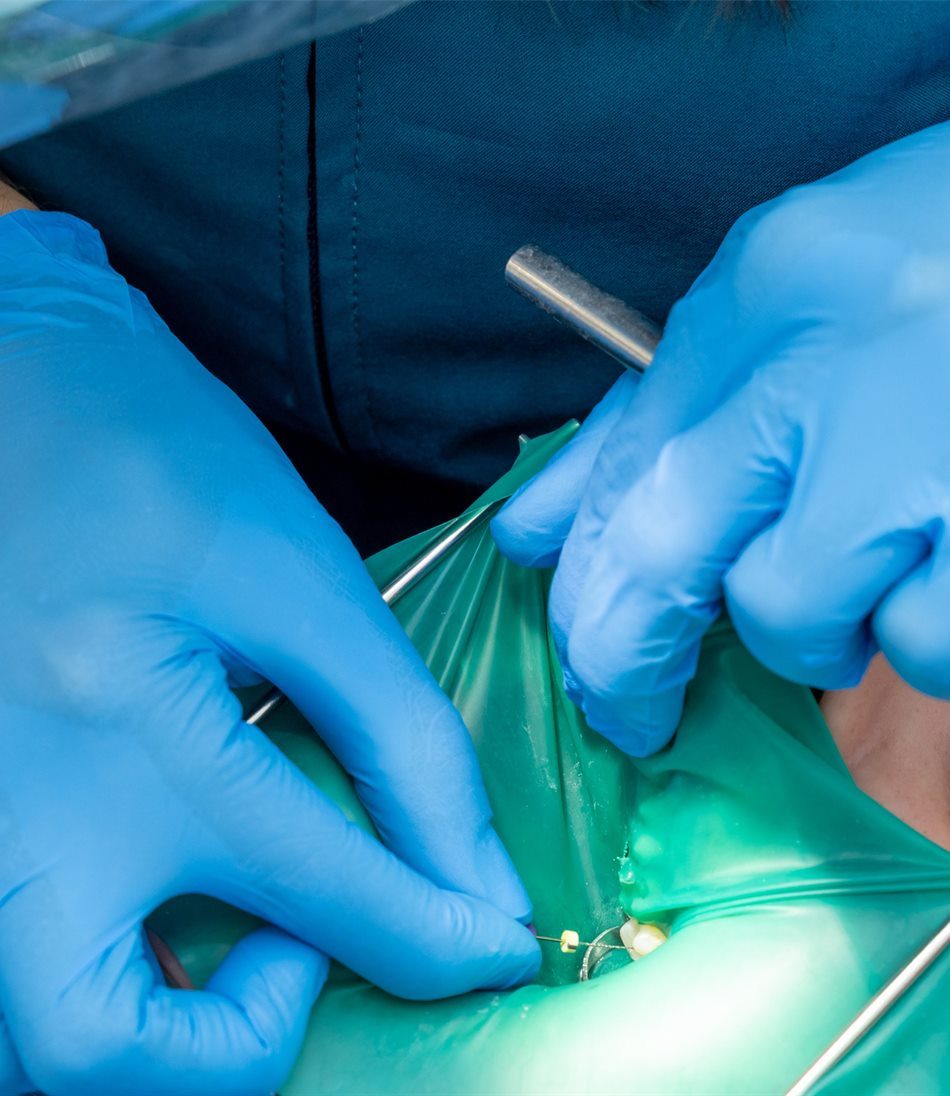 Tratamiento de endodoncia con dique de goma