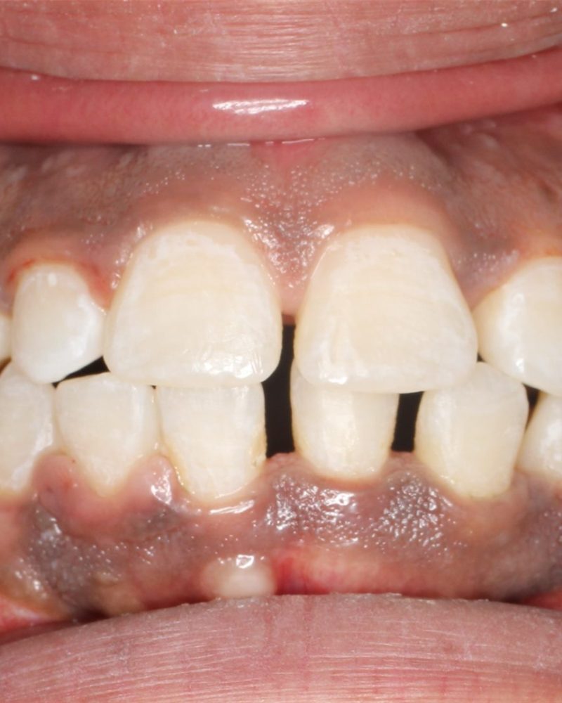 Caso de gingivectomía y microabrasión gingival
